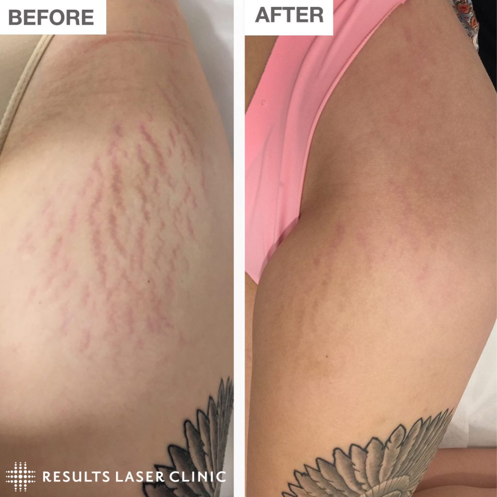 Results Laser Clinic Laser Hair Removal On Feedspot Rss Feed